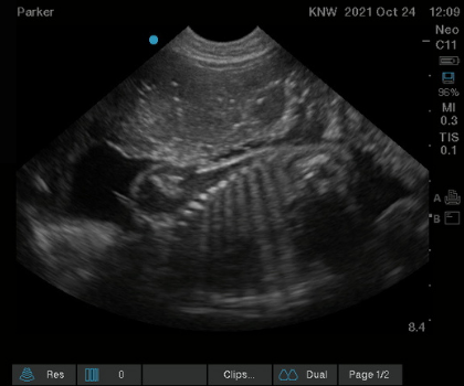 ultrasound